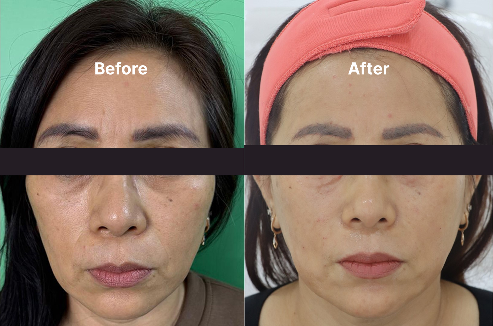 Upper Eyelid Thread Lift KOQ10